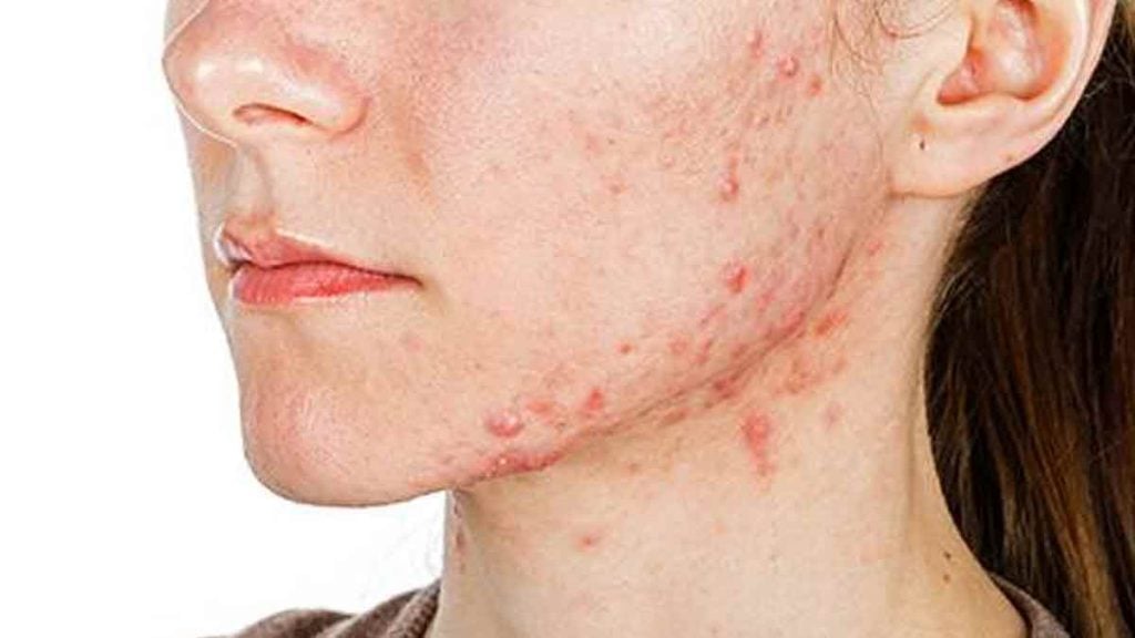 « À l’origine d’effets indésirables graves et susceptibles de persister après la fin du traitement »  le dangereux usage des médicaments contre l’acné se propage sur les réseaux sociaux